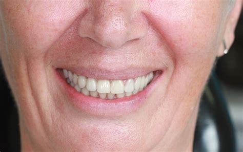 Dental Implants Whittle Dental