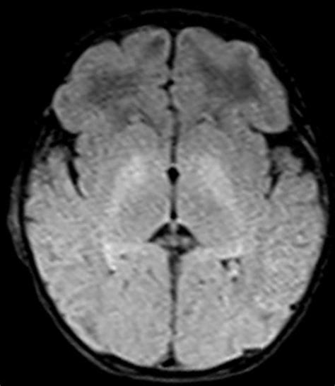 Kernicterus Bilirubin Encephalopathy The Third Eye Radiology Site