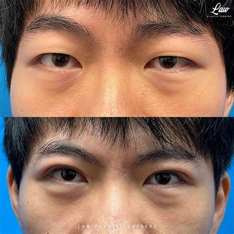 Asian Eyelid Surgery Before After Photos Law Plastic Surgery