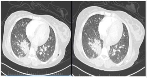 Computed Tomography Pulmonary Angiogram Scan Dilated Pulmonary Trunk Download Scientific