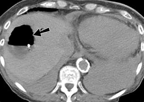 Postoperative Imaging In Liver Transplantation What Radiologists