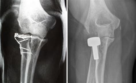 Radial head fracture