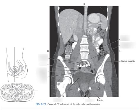 Computed Tomography Coronal Section Showing Left Pelvic Mass Hot Sex