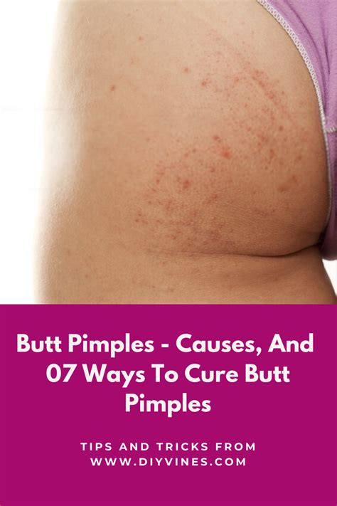 How To Get Rid Of Acne On Your Butt Artofit