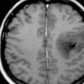 Irm Pr Op Ratoire Avec Injection De Contraste En Coupes Sagittale A