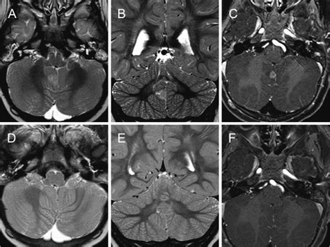 Evolution Of The Cerebellar Lesion On Brain Mri Study Axial Ad And