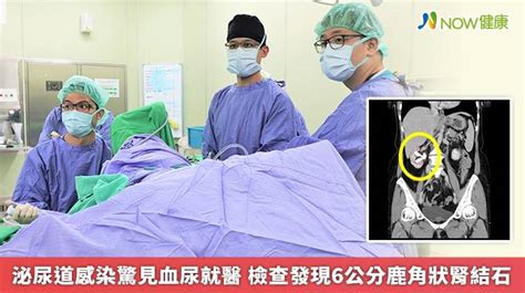 泌尿道感染驚見血尿就醫 檢查發現6公分鹿角狀腎結石 Now健康 Line Today