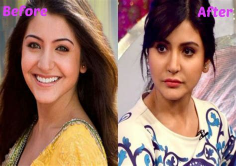 Anushka Sharma Plastic Surgery News | Celebrities Plastic Surgery | PSID