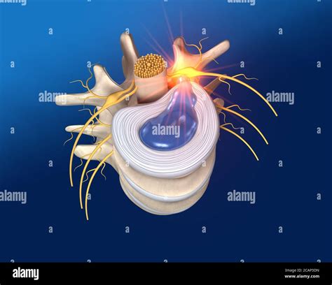 Illustration Showing Lumbal Vertebra With Intervertebral Disc And