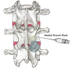 Medial Branch Block - Dr. Michael A. Castillo, MD