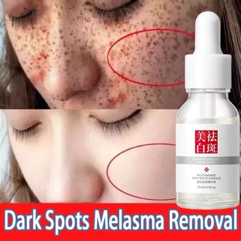 Jual Nicotinamide Whitening Serum Freckles Remove Dark Spots Melasma