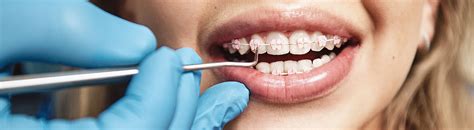 Caring For Orthodontic Braces From A Hygienist Moms Perspective