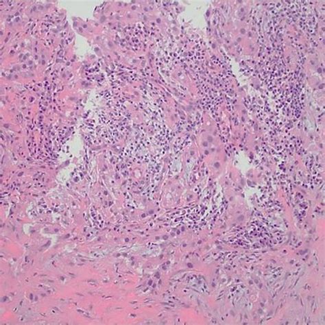 Histological confirmation of metastatic renal cell carcinoma from the ...