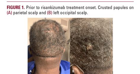 Hidradenitis Suppurativa Scalp