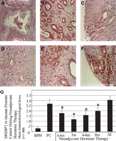 Sterol Response Element Binding Protein Srebp Is Elevated In