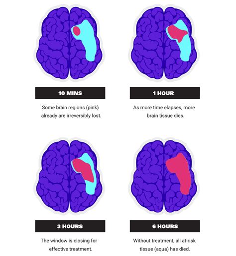 Life after stroke: The discovery set to halt brain damage in its tracks ...