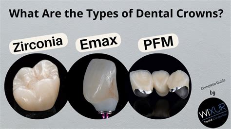 What Are The Types Of Dental Crowns Youtube