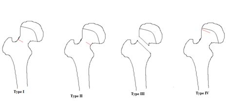 Femoral Neck Stress Fracture Orthopedics Notes