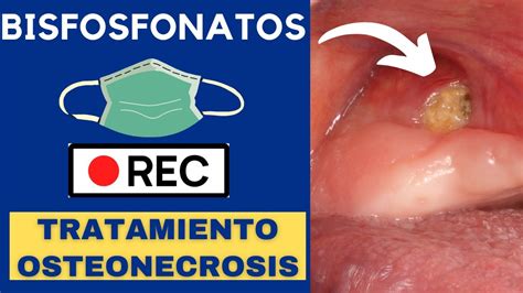 Tratamiento De Osteonecrosis Maxilar Por Bisfosfonatos Cirug A En