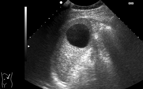 Sonography Of The Spleen Benter 2011 Journal Of Ultrasound In