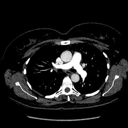 Pulmonary Embolism Protocol Chest Ct Scan | Hot Sex Picture