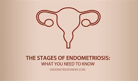 The Stages of Endometriosis: What You Need to Know