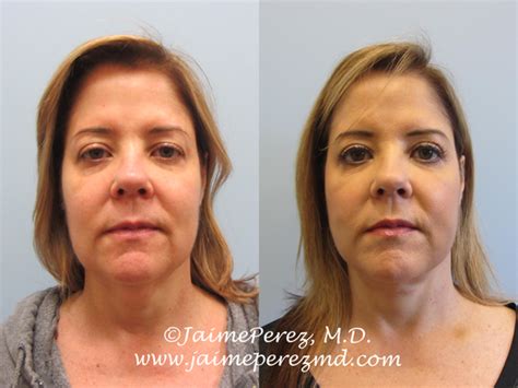 52 Year Old Woman - New Look - Facelift - Before and After Gallery