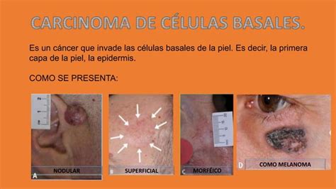 Carcinoma De Celulas Basales Pptx