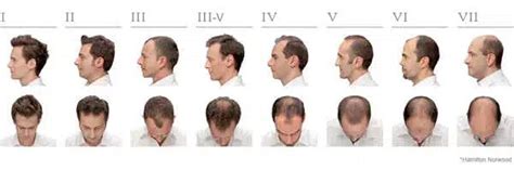 Understanding The Norwood Stages Of Male Pattern Baldness Microhair