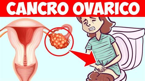 Segni Premonitori Di Cancro Ovarico A Cui Prestare Attenzione Youtube