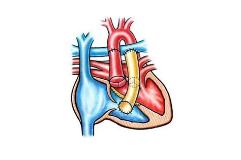 Truncus Arteriosus Comm Universitätsklinik Für Herzchirurgie