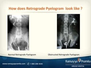 Retrograde Pyelography An Overview ScienceDirect Topics, 50% OFF