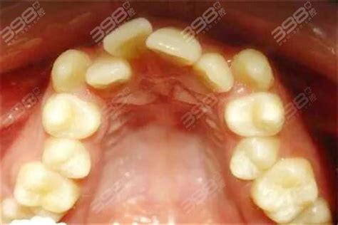 深圳龙华区牙齿矫正要多少钱？深圳龙华牙科医院戴牙套、正畸价格公开 口腔医院新闻 398口腔网