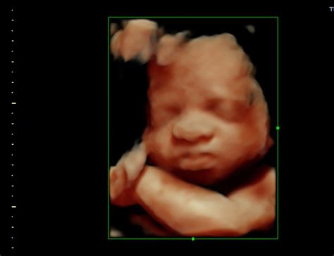 How will your baby look in a 3D ultrasound?