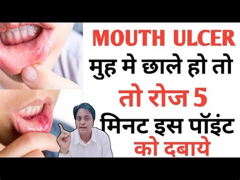 Acupressure Points For Mouth Ulcer Sujok Therapy