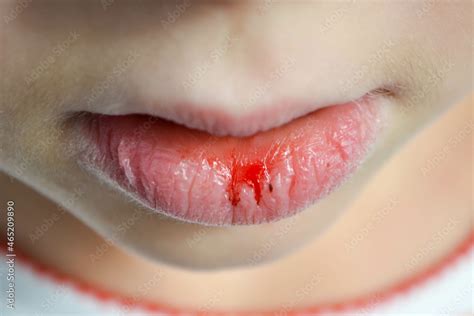 Dry Cracking Lips At Manuel Bridges Blog