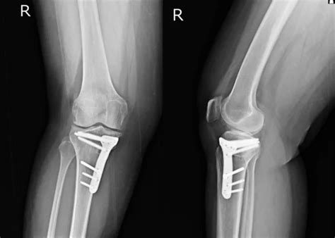 Knee x ray Images - Search Images on Everypixel