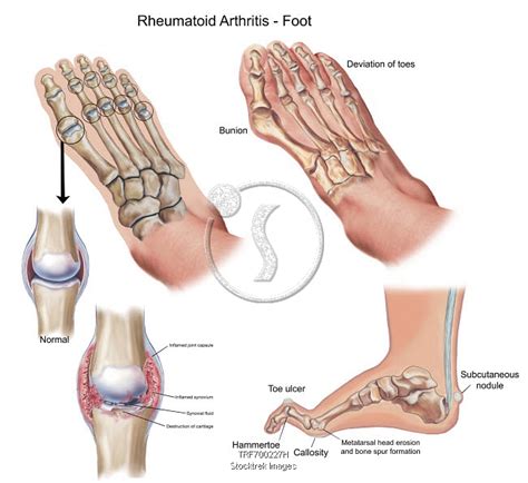 Rheumatoid Arthritis Feet