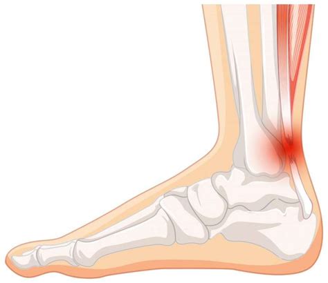 Treating Achilles Tendon Issues With Laser Therapy Berman Partners Medical Lasers