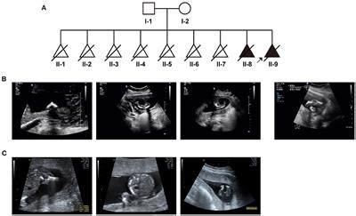 Frontiers Case Report Exome Sequencing Identified A Novel Compound