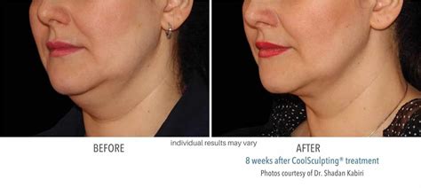 Coolsculpting Elite Before And After X The Results In Half The Time