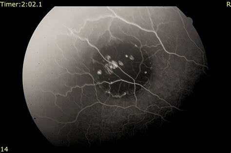 Congenital Hypertrophy Of The Retinal Pigment Epithelium Pigmented