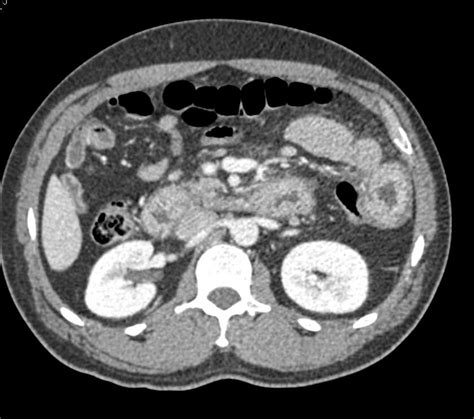 Infectious Enteritis Involving The Small Bowel Small Bowel Case