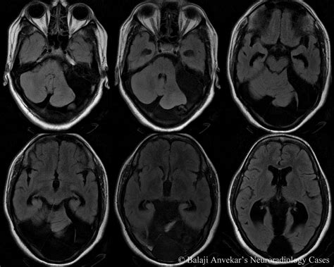 Dr Balaji Anvekar FRCR: Posterior Fossa Arachnoid cyst MRI