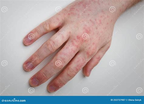 Allergy Red Itchy Rash On Male Hand On White Table Dermatological