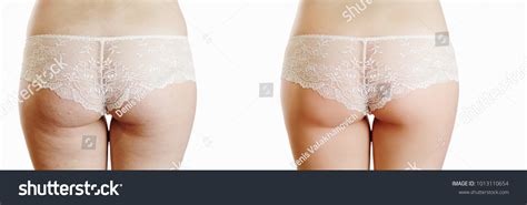 Female Buttocks Cellulite Before After On Shutterstock