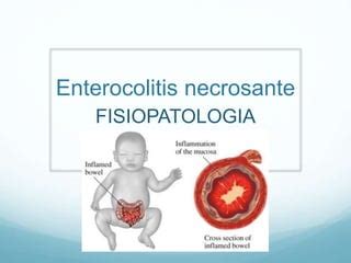 Enterocolitis Necrotizante Ppt