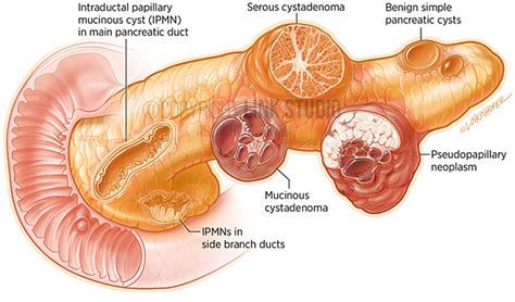 Pancreatic Cysts - Link Studio - Medical Illustration