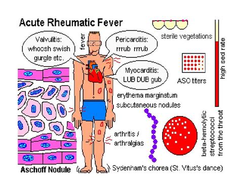 Rheumatic Heart Disease