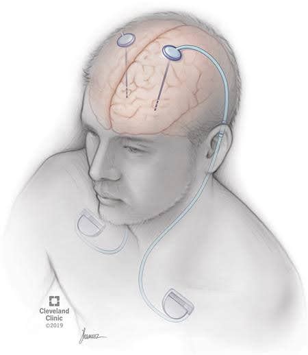 La Estimulaci N Cerebral Profunda Calma Los Temblores Y Reduce Los